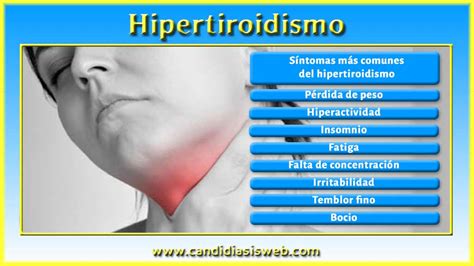 hipertiroidismo síntomas - síntomas de ansiedad